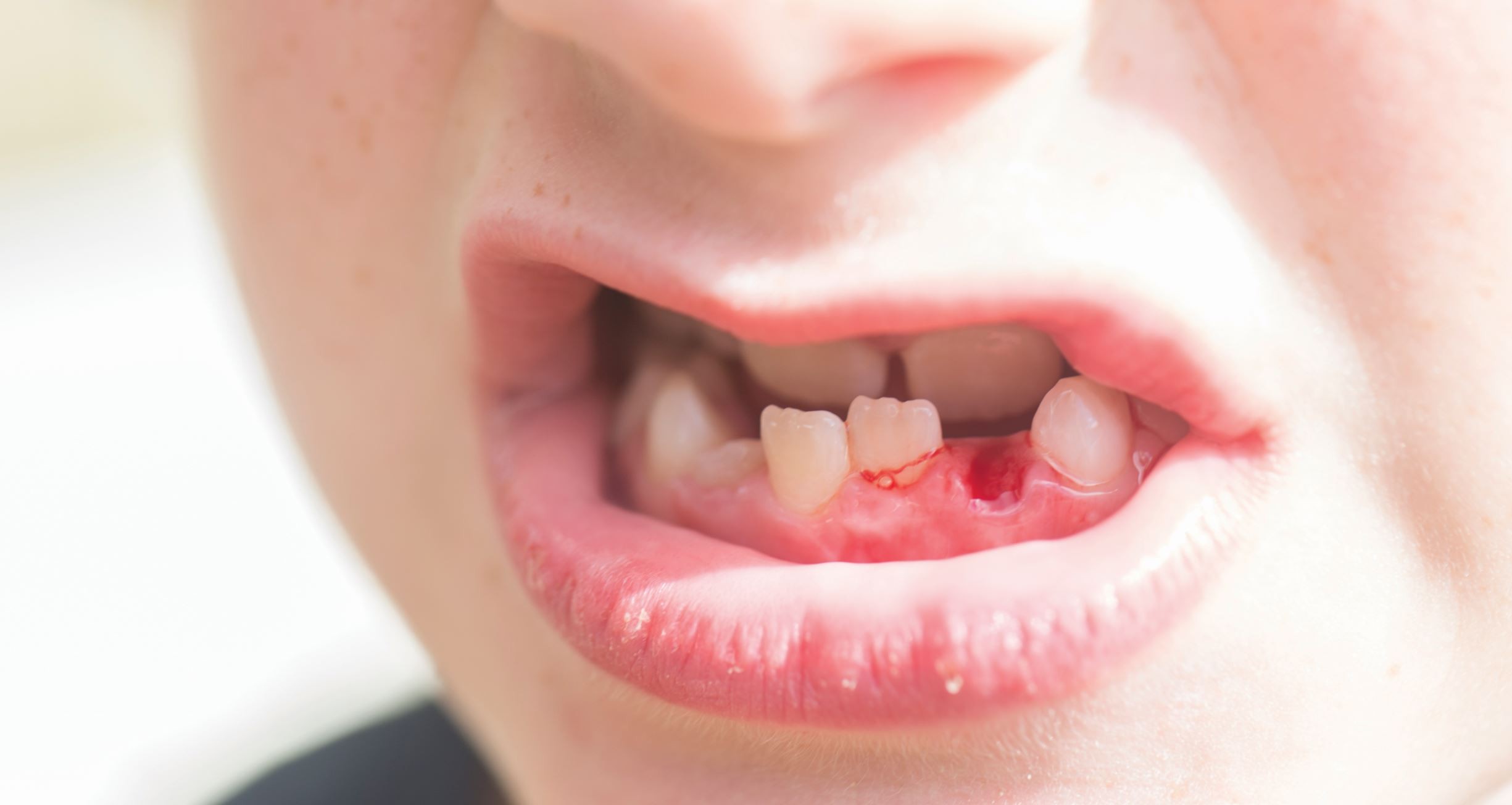 What Do You Need To Know About Teeth Avulsion